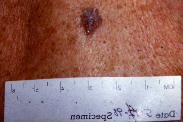 Melanoma (46)