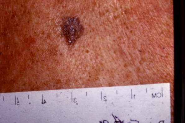 Melanoma (48)