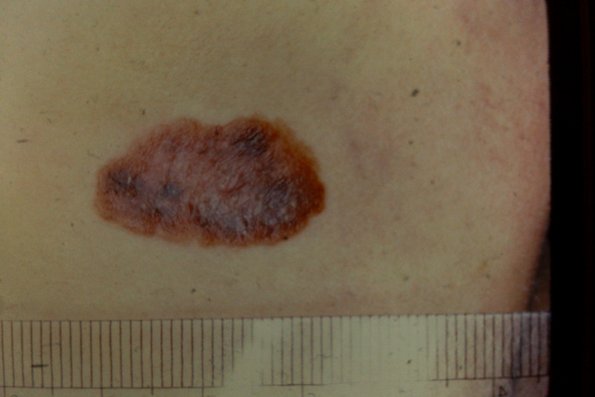 Melanoma (5)