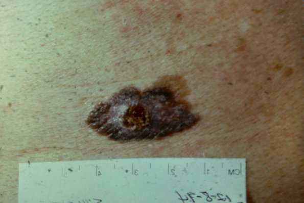 Melanoma (51)