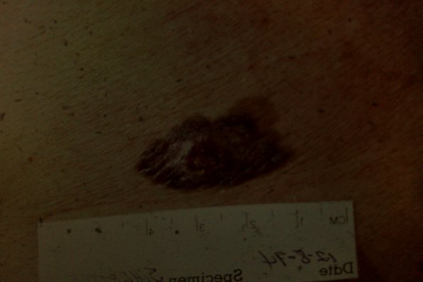 Melanoma (53)