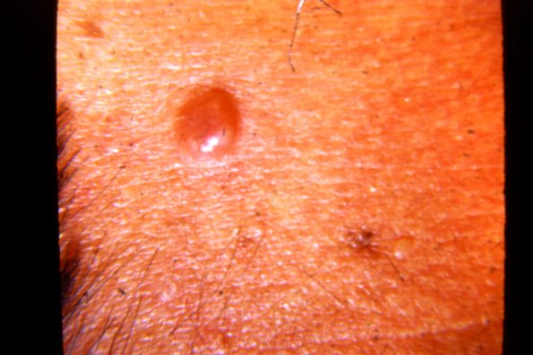 Melanoma (72)