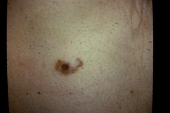 Melanoma (74)