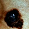 Melanoma (77)