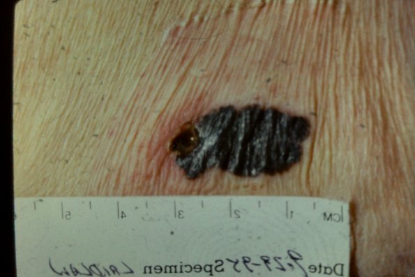 Melanoma (9)