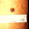 Sup. Spr. Melanoma