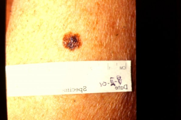 Sup. Spr. Melanoma