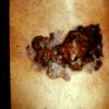 Superficial Spreading Malignant Melanoma (2)