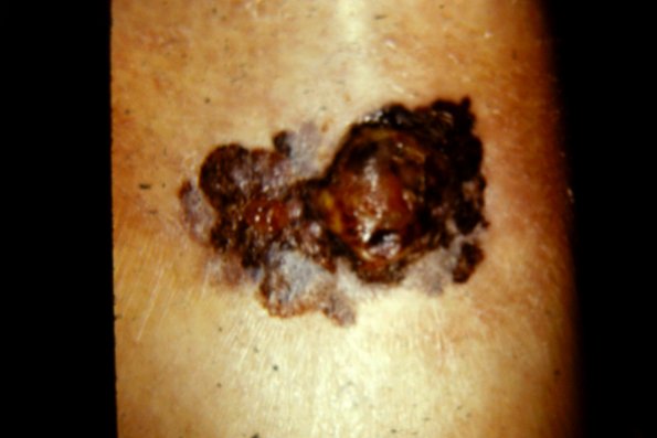 Superficial Spreading Malignant Melanoma (2)