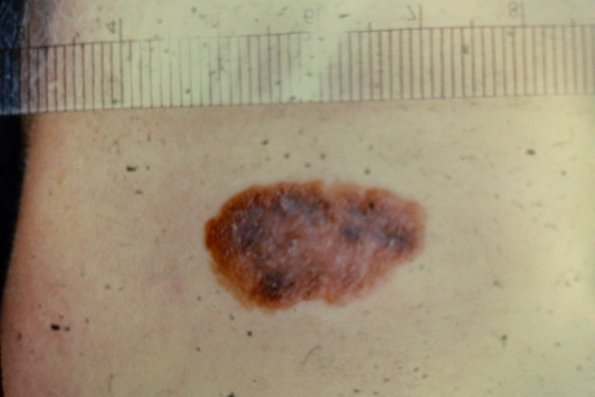 Superficial Spreading Malignant Melanoma