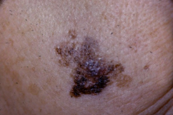 melanoma copy 2