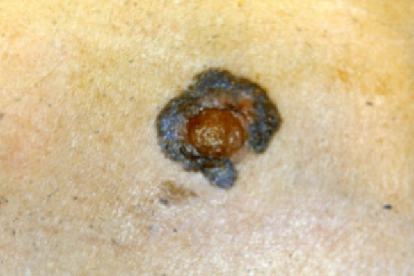 melanoma copy