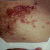 LymphAngioma