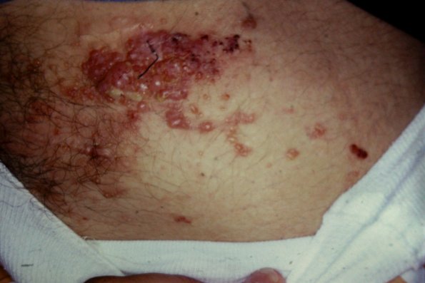 LymphAngioma