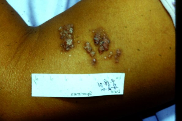 Lymphangioma (2)