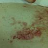 Lymphangioma (8)