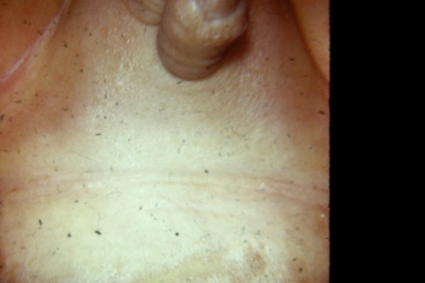 Candidiasis (2)