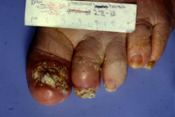 Psoriasis + Candidiosis