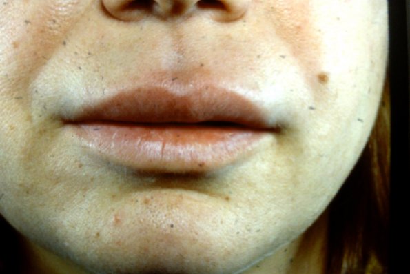 Cheilitis Granuloma