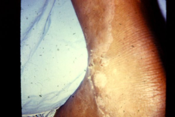 Congenital Ichthyosis (2)