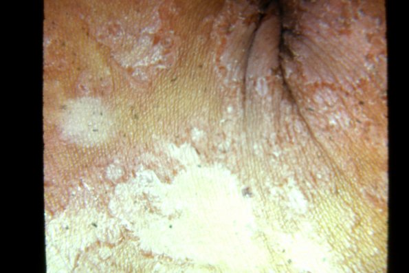 Congenital Ichthyosis (5)