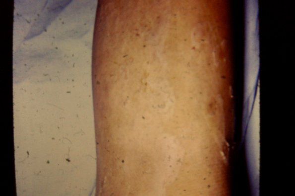 Congenital Ichthyosis (6)