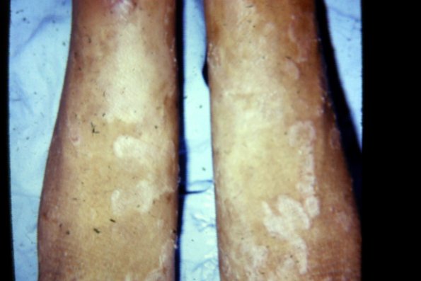 Congenital Ichthyosis (8)