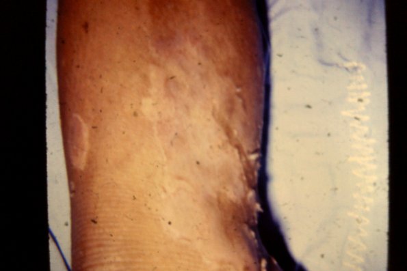 Congenital Ichthyosis