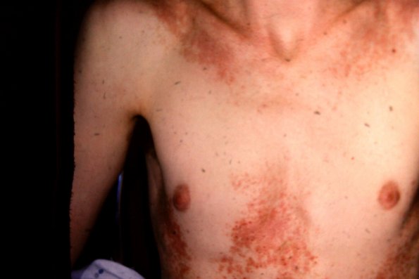 Darrier's Disease (13)