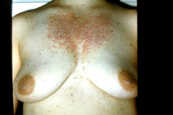 Derier Keratosis Follicularis (5)