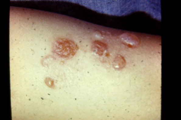 Dermatitis Herpetiformis (19)