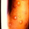 Dermatitis Herpetiformis (21)