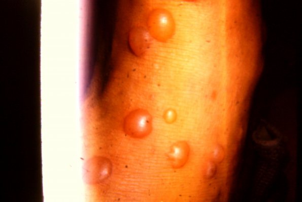 Dermatitis Herpetiformis (21)