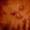 Dermatitis Herpetiformis (22)
