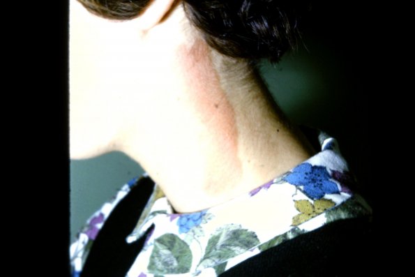 Berloque Dermatitis