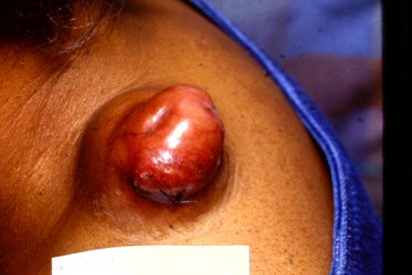 Dermatofibrosarcoma Protuberans