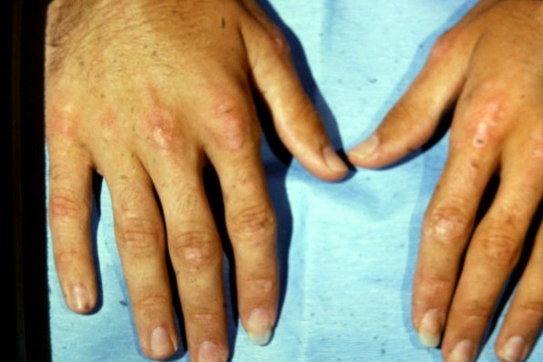 Dermatomyositis (15)