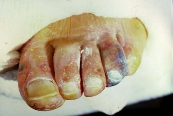 Diabetic Gangrene