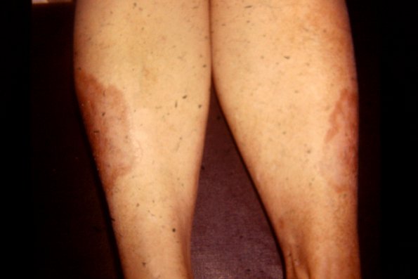 Necrobiosis Lipoidica Diabeticurum (3)