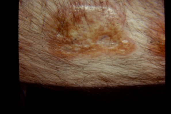 Necrobiosis Lipoidica Diabeticurum