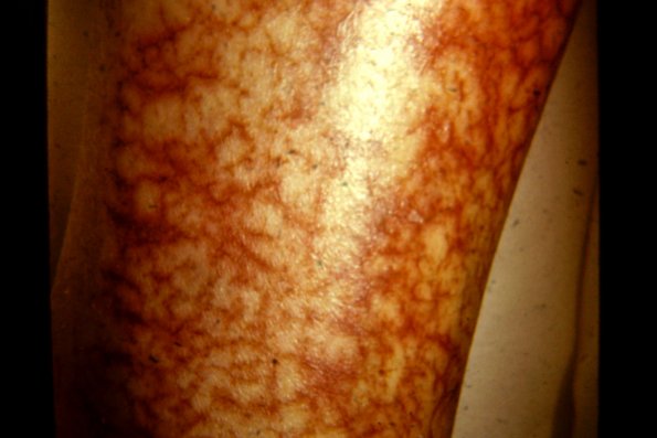 Eczema Craqule