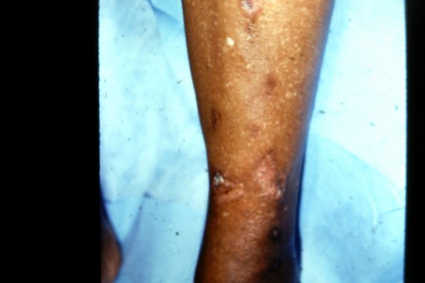 Eosinophilic Pustular Folliculitis (2)