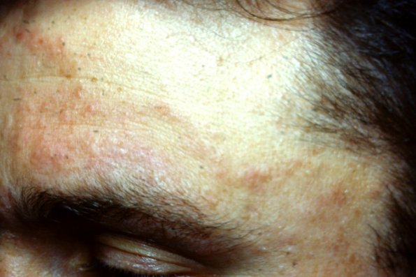 Ofugi's Eosinophilic Folliculitis