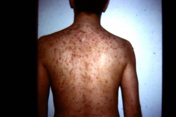 eosinophilic pustular folliculitis copy