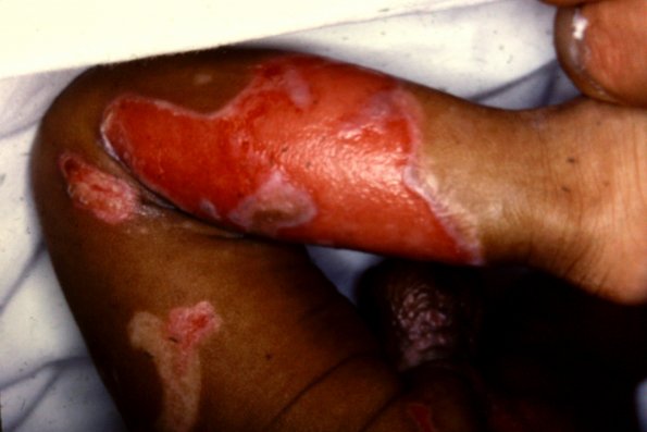 Epidermolysis Bullosa (12)