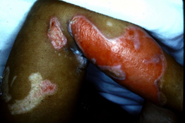 Epidermolysis Bullosa (27)