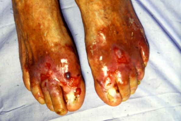 Epidermolysis Bullosa (28)