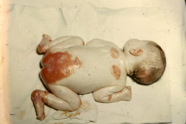 Epidermolysis Bullosa Dystrophica (2)