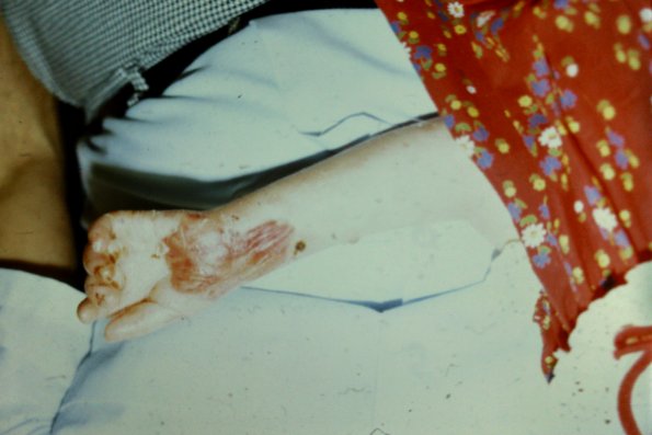 Epidermolysis Bullosa Dystrophica (3)