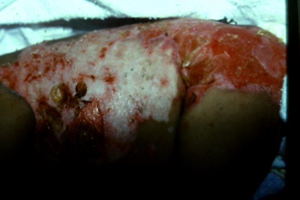 Epidermolysis Bullosa Letalis (2)